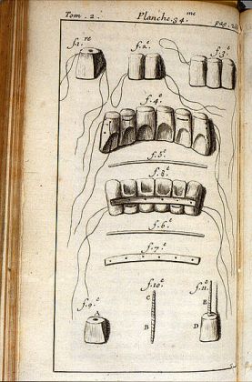 Fauchard, procedure for teeth restoration. Image @Wikimedia